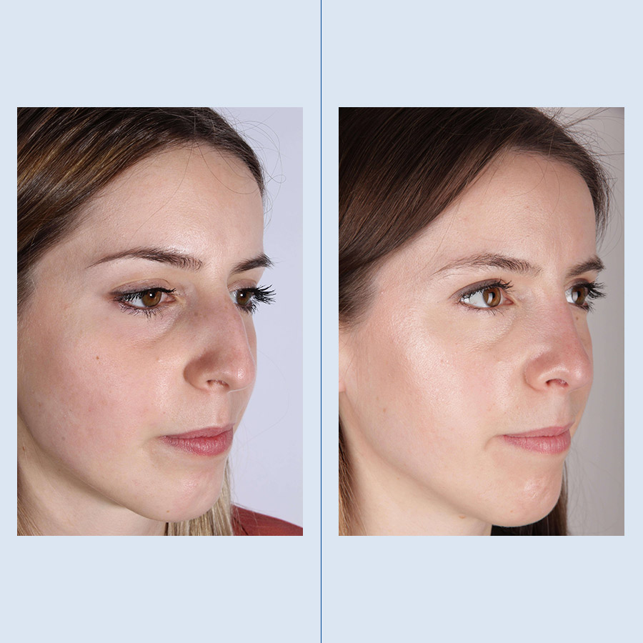 Rinoplastia Ultrasónica