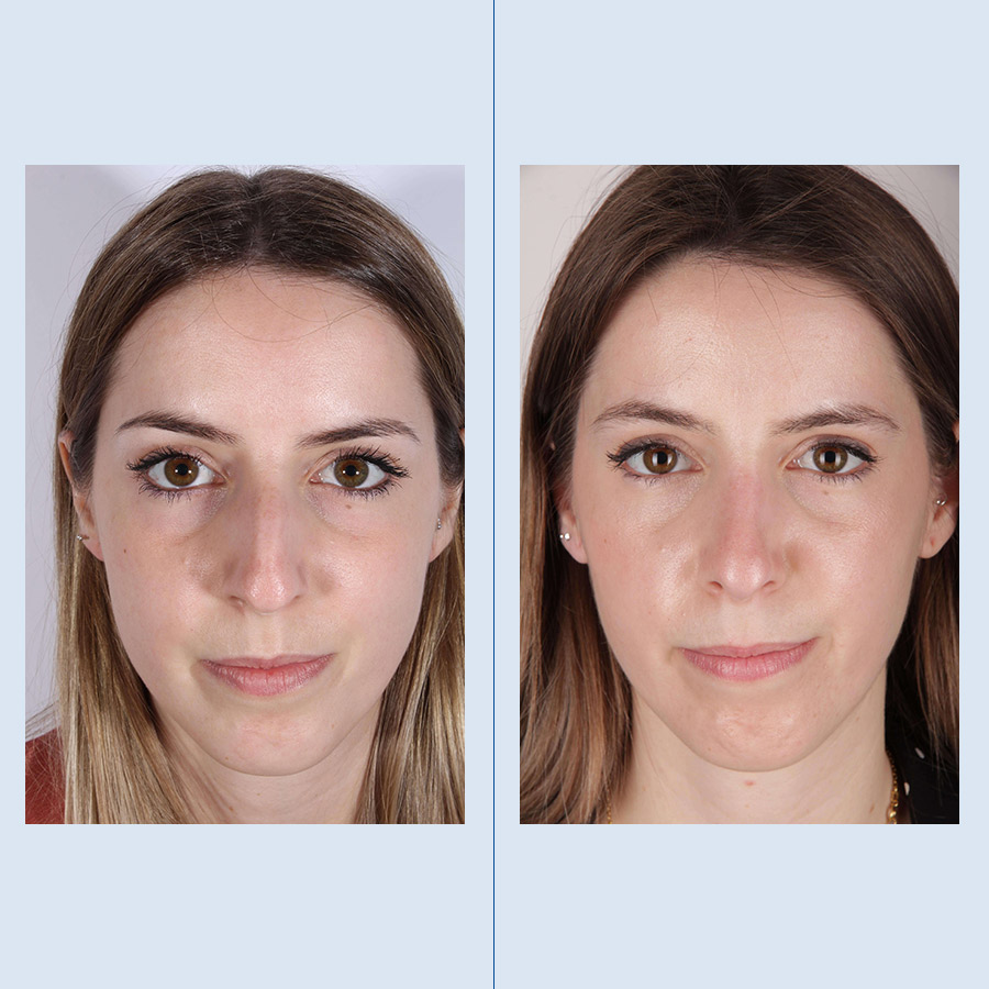 Rinoplastia Ultrasónica