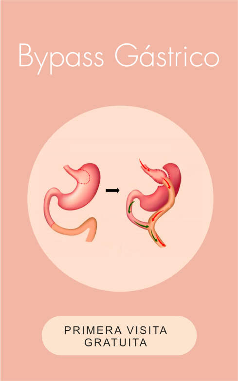 Obesidad - ByPass Gástrico
