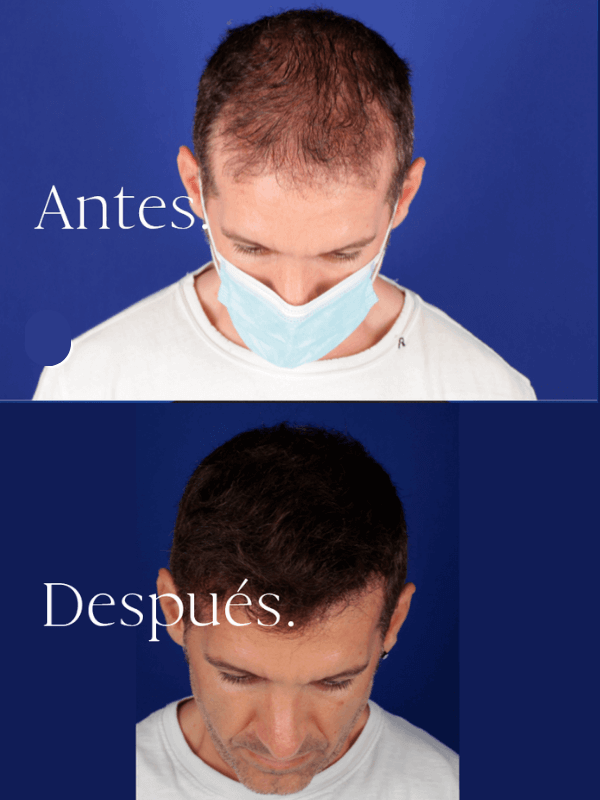 Microinjerto Capilar antes y después