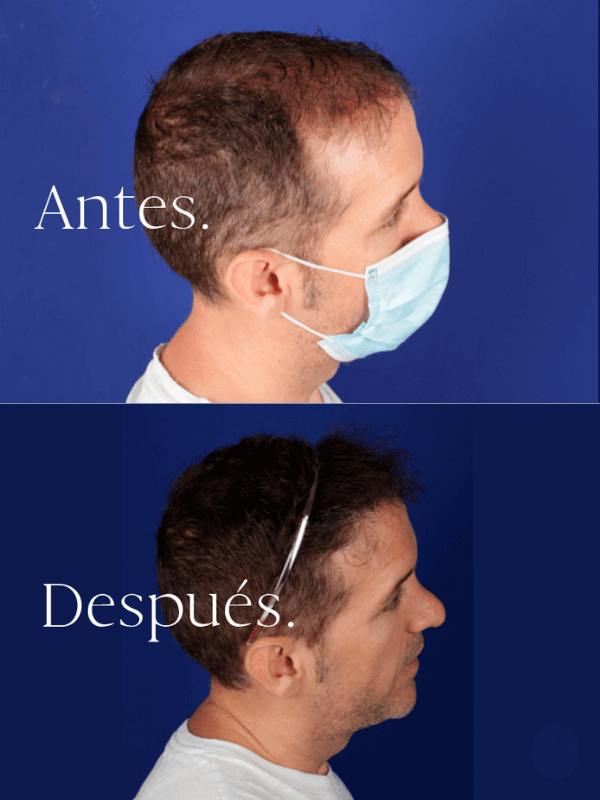 Microinjerto Capilar antes y después
