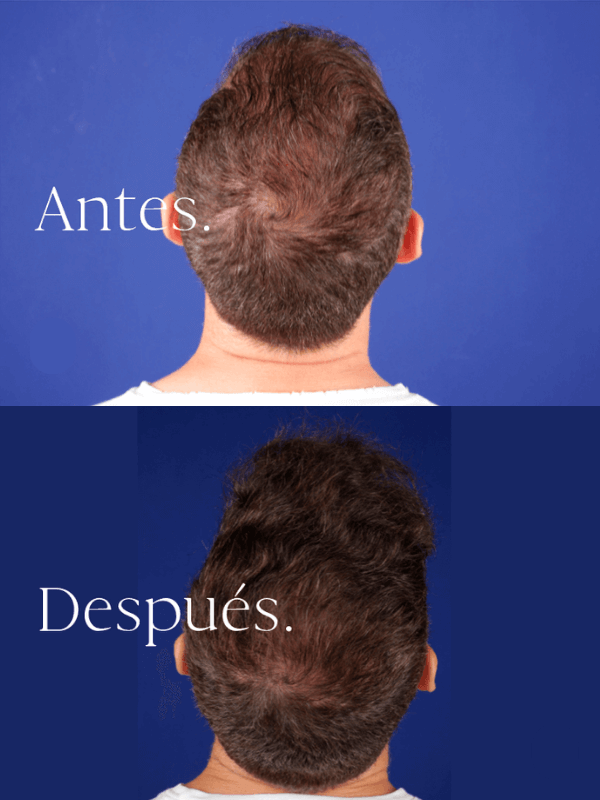 Microinjerto Capilar antes y después