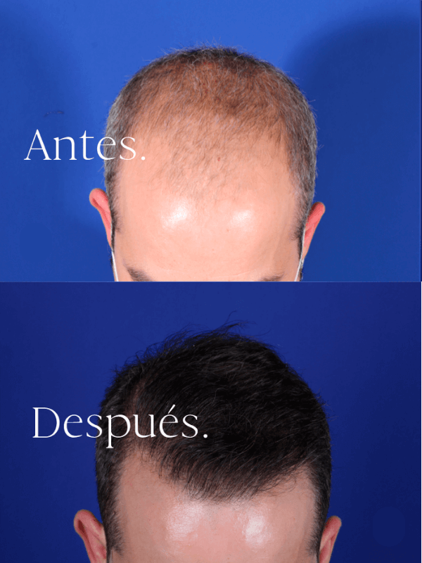Microinjerto Capilar antes y después