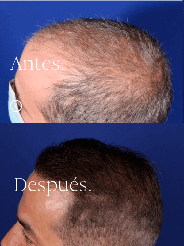 Microinjerto Capilar antes y después