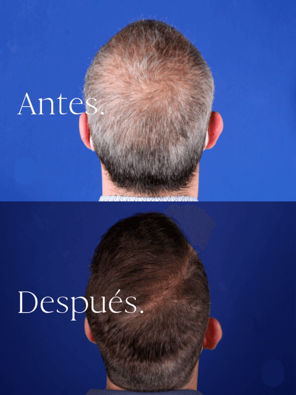 Microinjerto Capilar antes y después