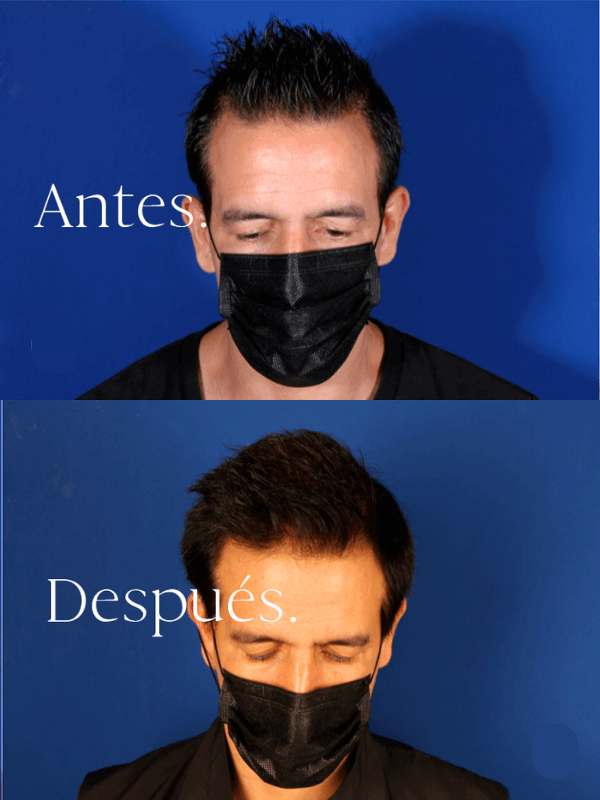 Microinjerto Capilar antes y después