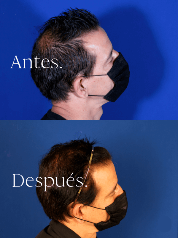 Microinjerto Capilar antes y después