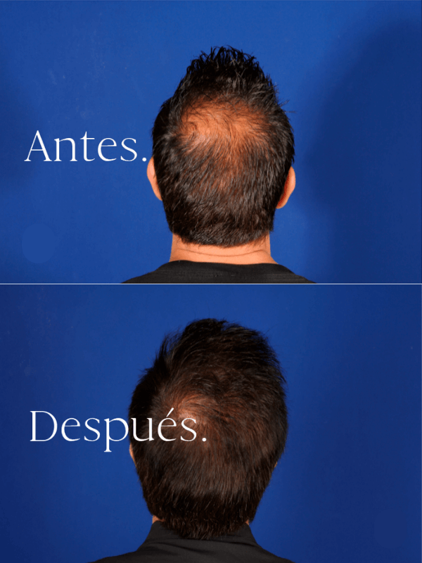 Microinjerto Capilar antes y después