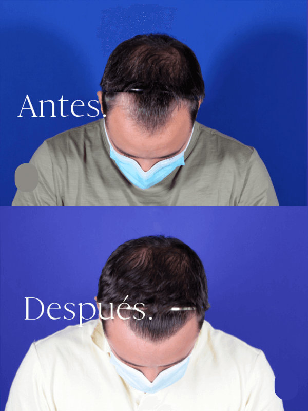 Microinjerto Capilar antes y después