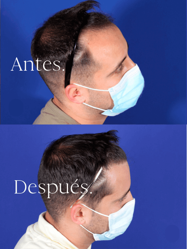 Microinjerto Capilar antes y después