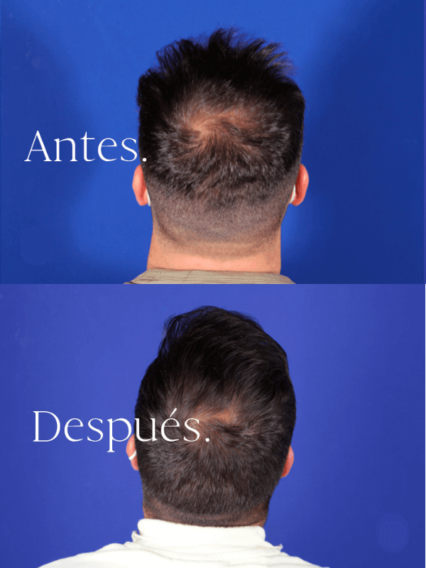 Microinjerto Capilar antes y después