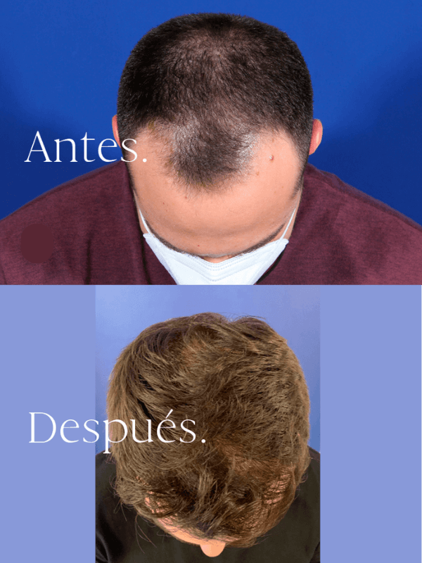 Microinjerto Capilar antes y después