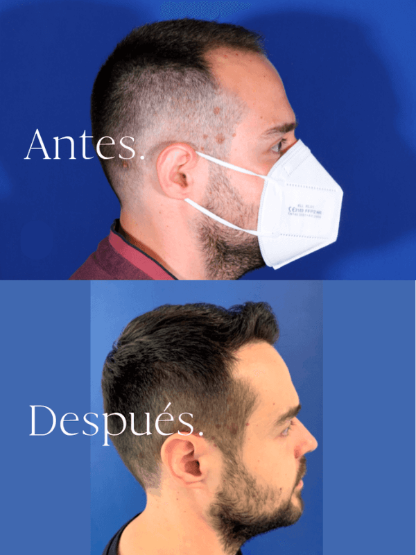 Microinjerto Capilar antes y después