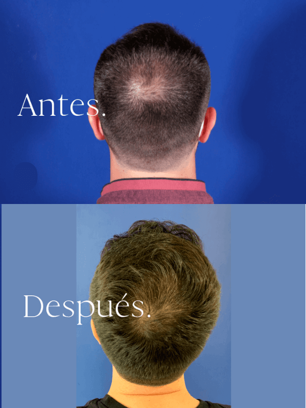 Microinjerto Capilar antes y después