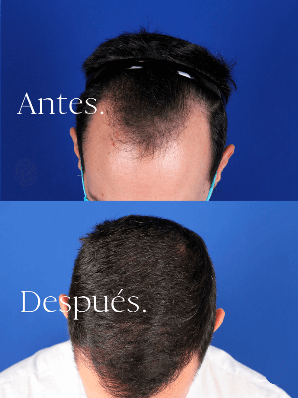 Microinjerto Capilar antes y después