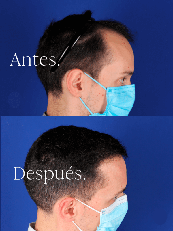 Microinjerto Capilar antes y después