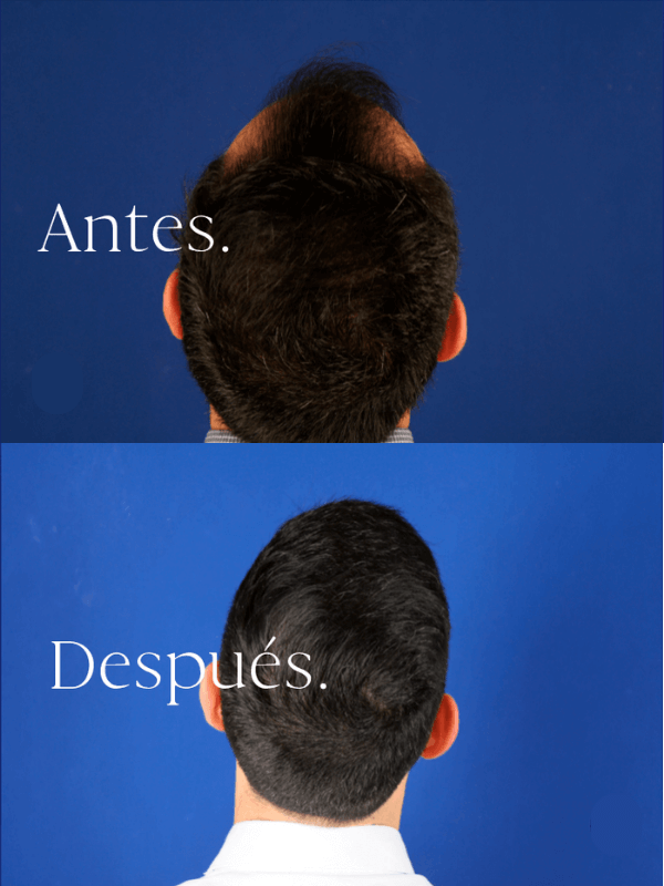 Microinjerto Capilar antes y después