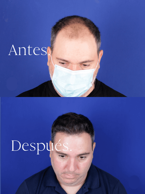 Microinjerto Capilar antes y después