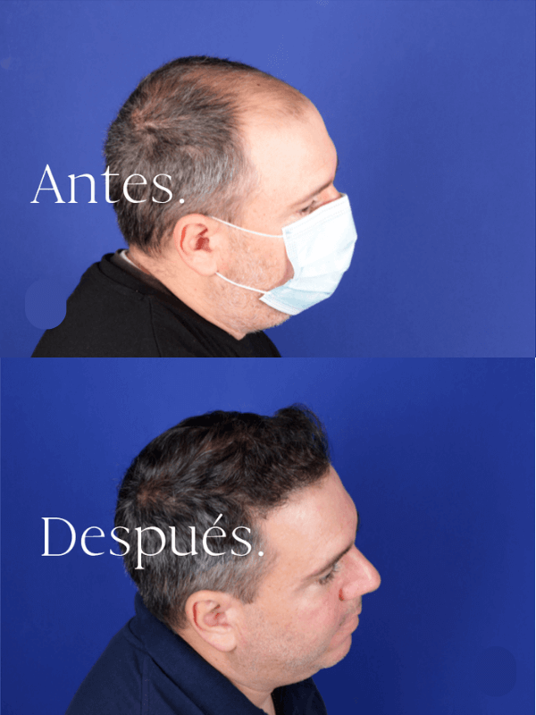 Microinjerto Capilar antes y después