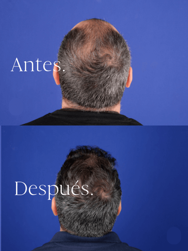 Microinjerto Capilar antes y después