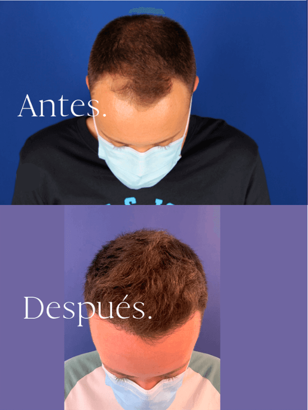 Microinjerto Capilar antes y después