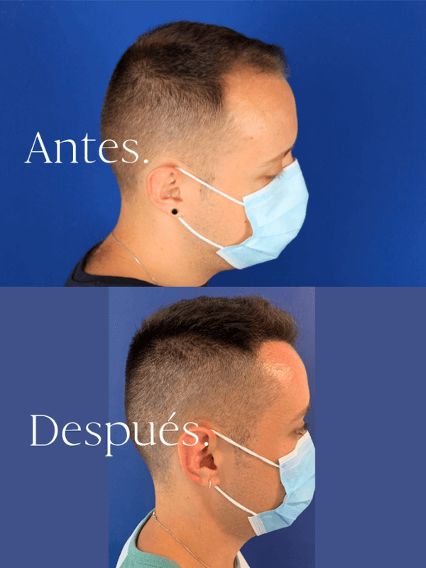 Microinjerto Capilar antes y después