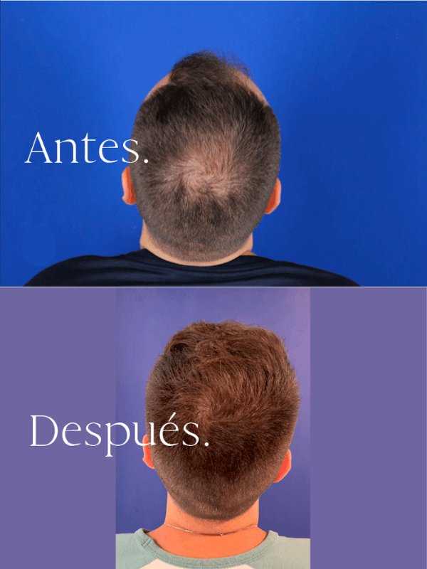 Microinjerto Capilar antes y después
