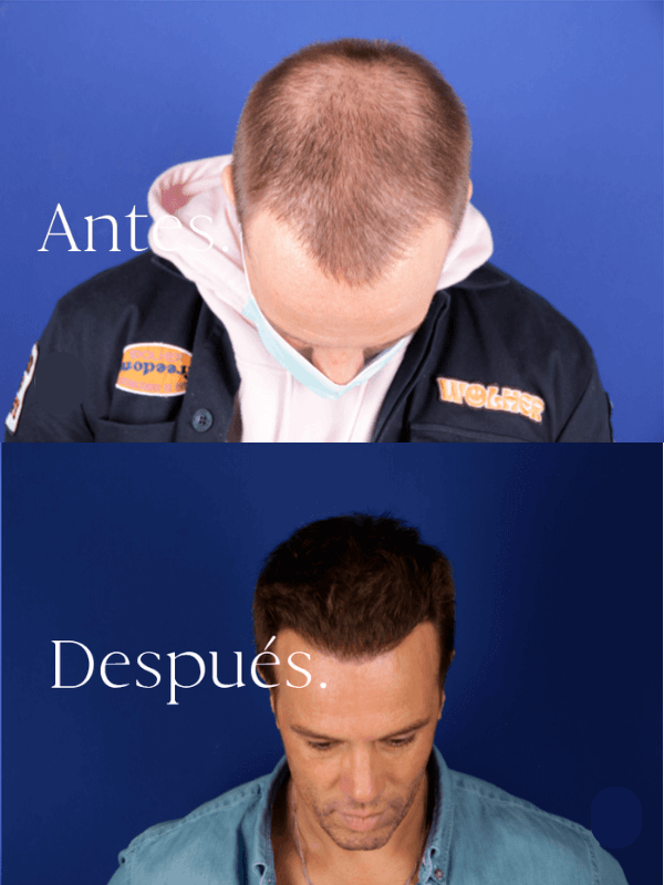 Microinjerto Capilar antes y después
