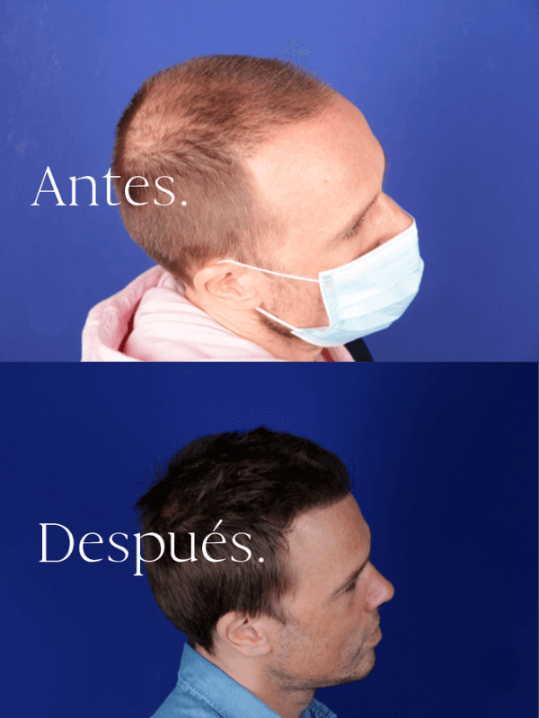Microinjerto Capilar antes y después