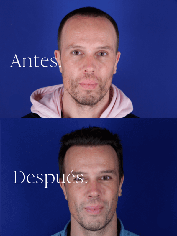 Microinjerto Capilar antes y después