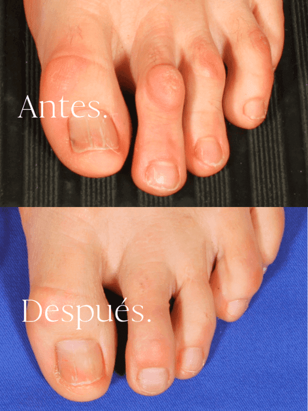 Acortamiento de dedos del pie
