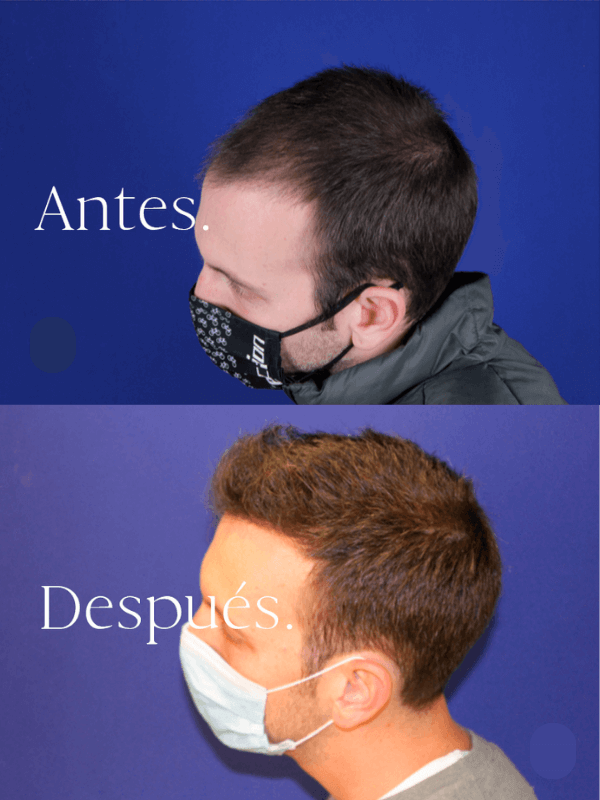 Microinjerto Capilar antes y después
