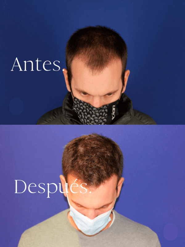 Microinjerto Capilar antes y después