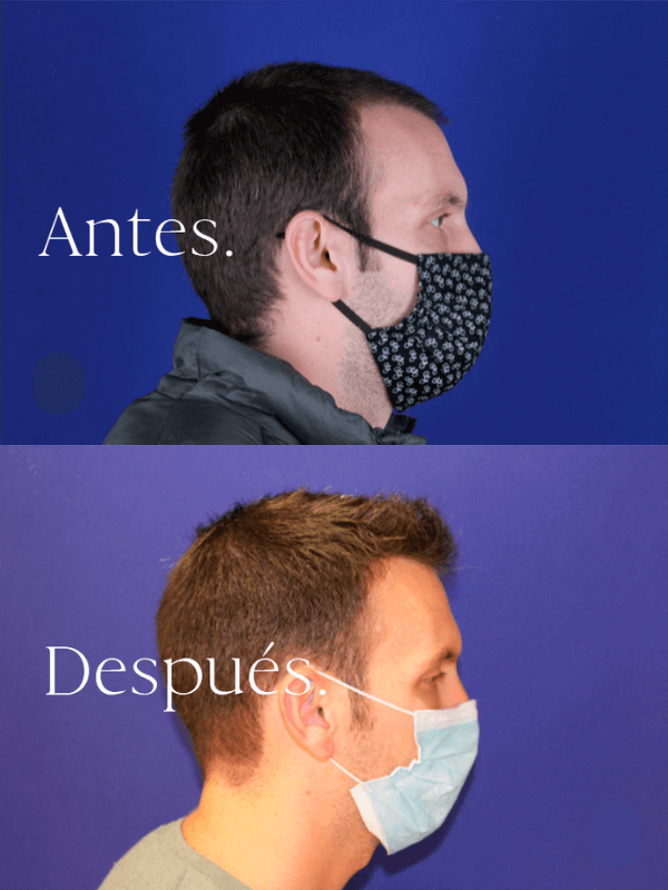 Microinjerto Capilar antes y después
