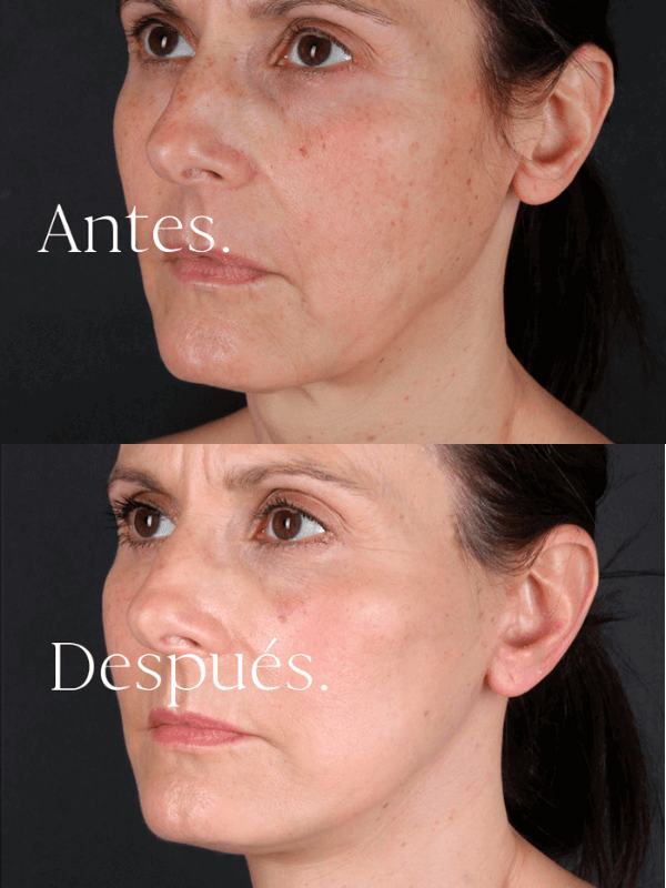 Lifting Facial antes y después
