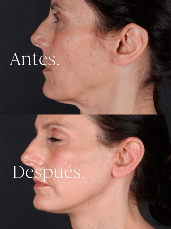 Lifting Facial antes y después