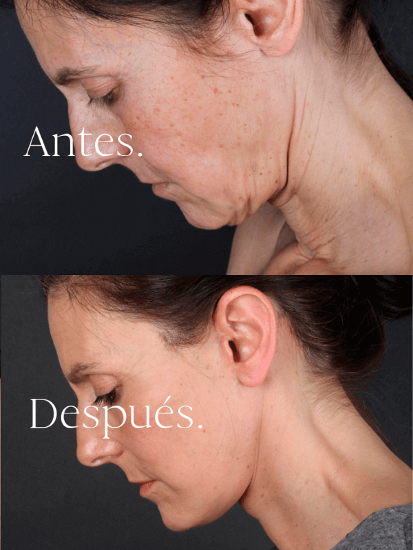 Lifting Facial antes y después