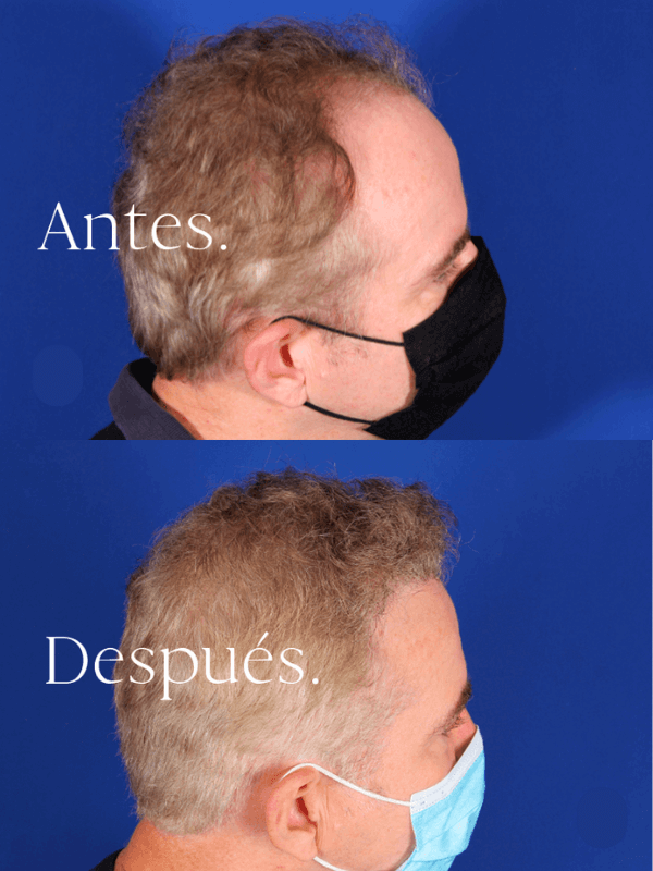Microinjerto Capilar antes y después
