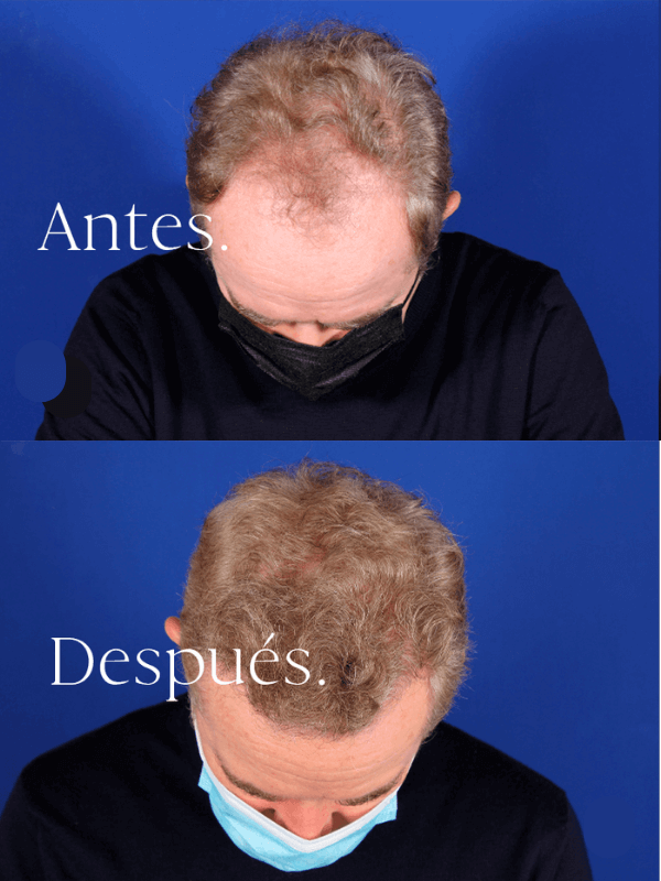 Microinjerto Capilar antes y después