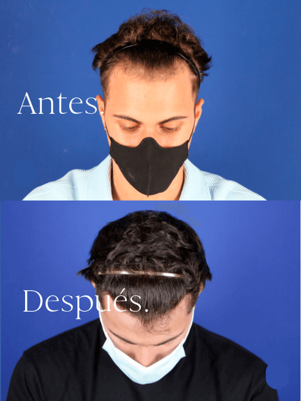 Microinjerto Capilar antes y después