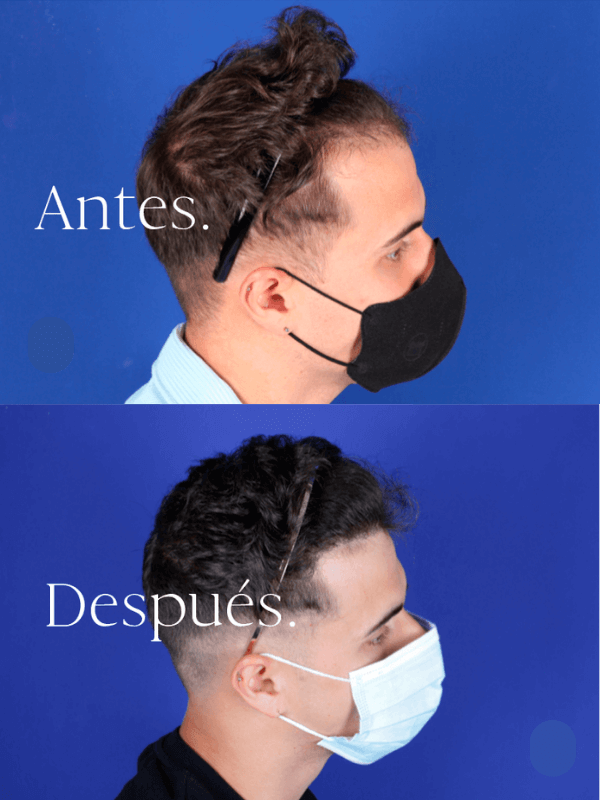 Microinjerto Capilar antes y después