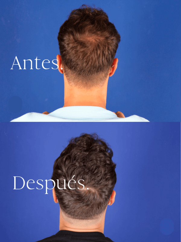 Microinjerto Capilar antes y después