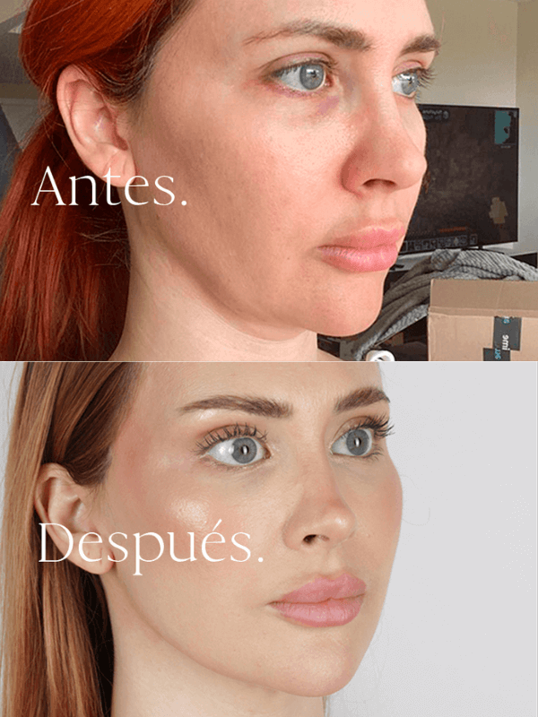 Lifting Facial antes y después
