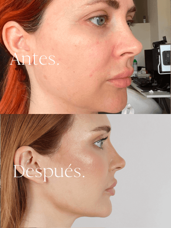 Lifting Facial antes y después