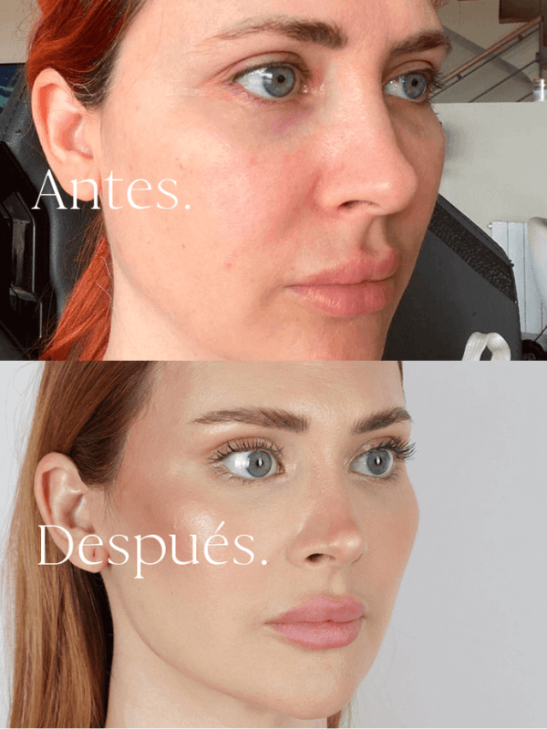 Lifting Facial antes y después