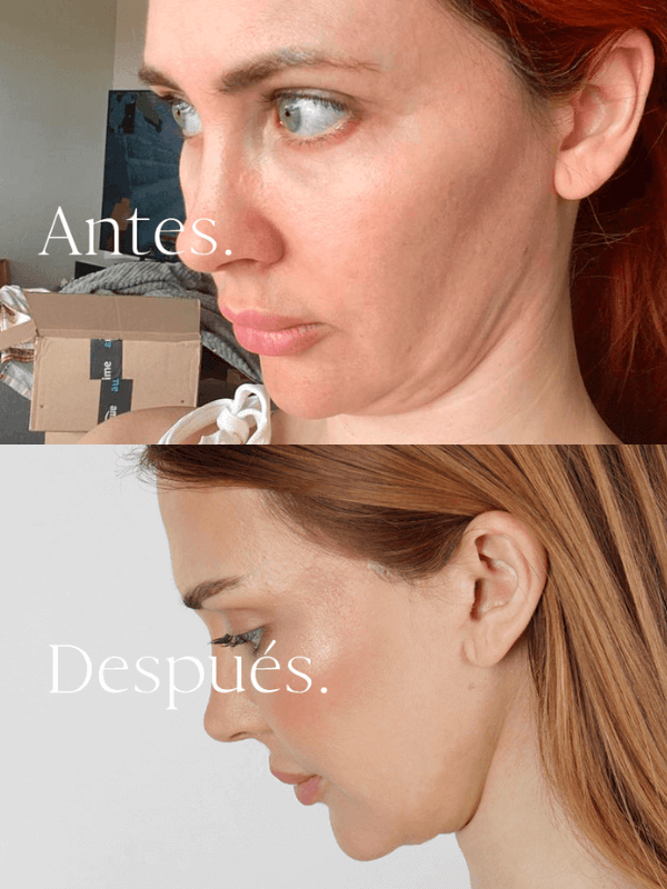 Lifting Facial antes y después