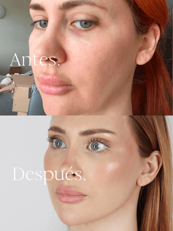 Lifting Facial antes y después