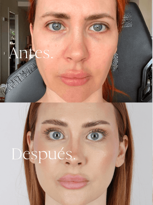 Lifting Facial antes y después