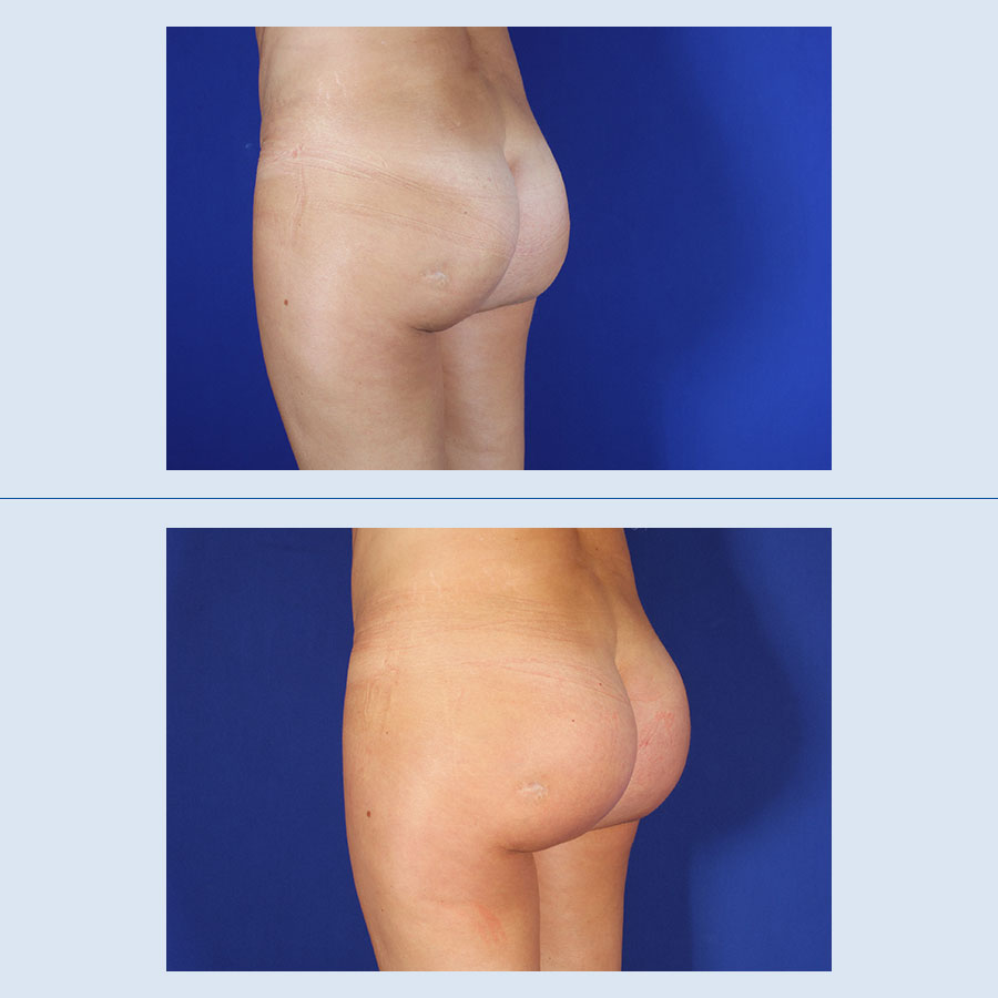 Antes y Después Gluteus Augmentation