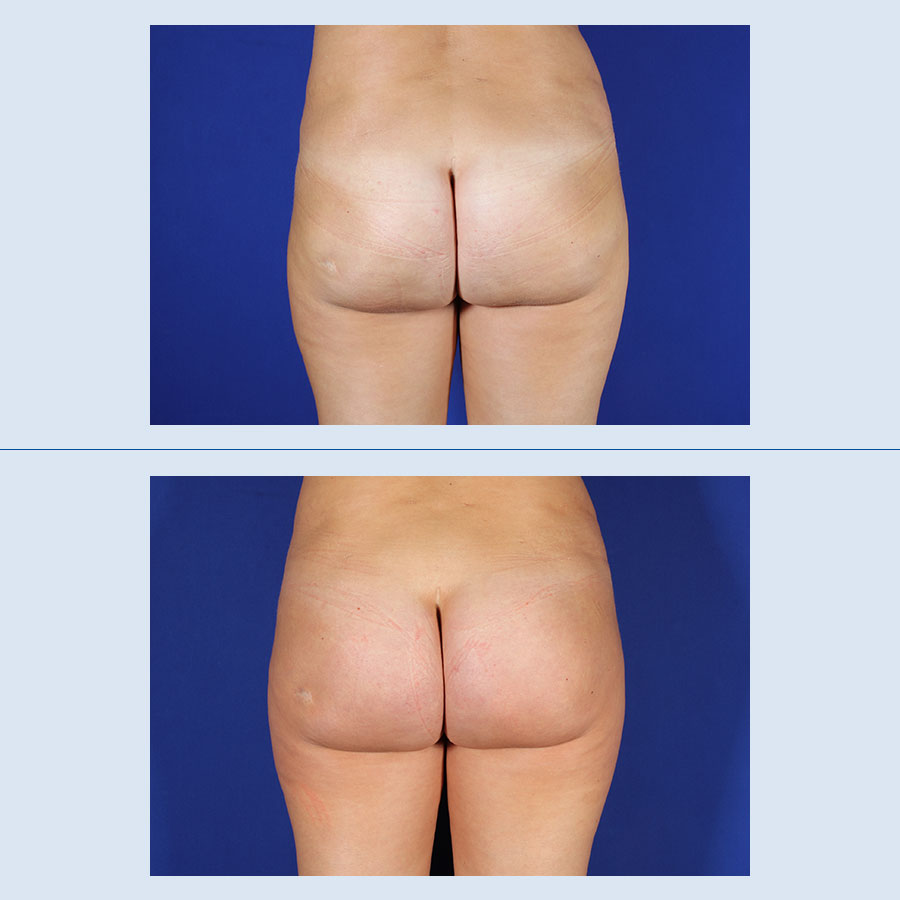 Antes y Después Gluteus Augmentation